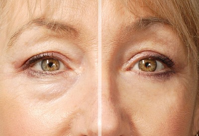 Eyesential20beforeafter20female400